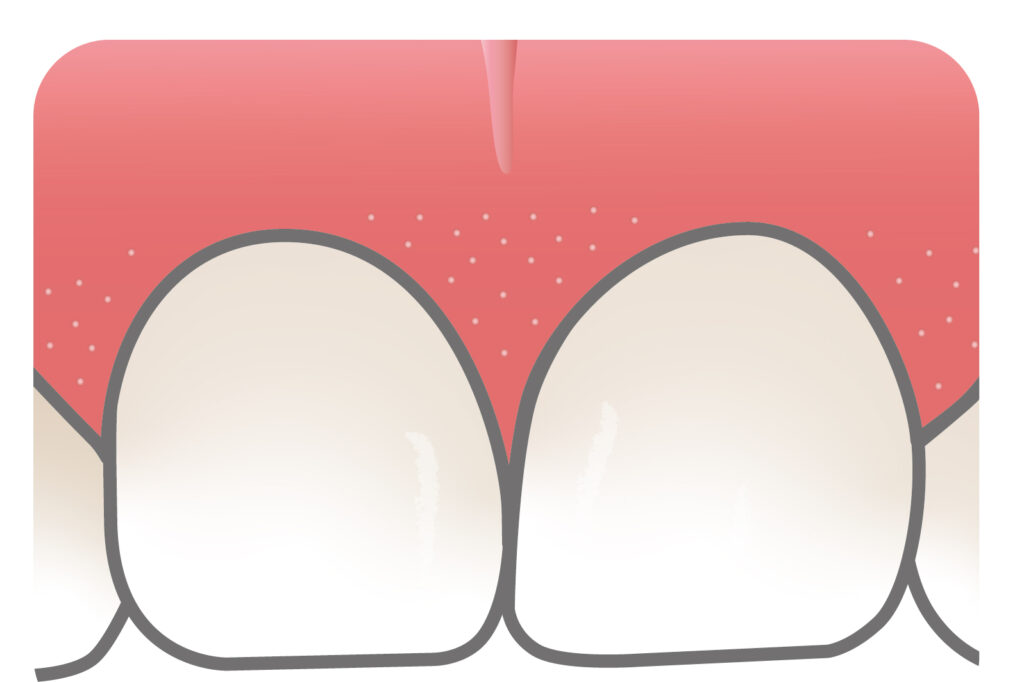 歯２本のイラスト