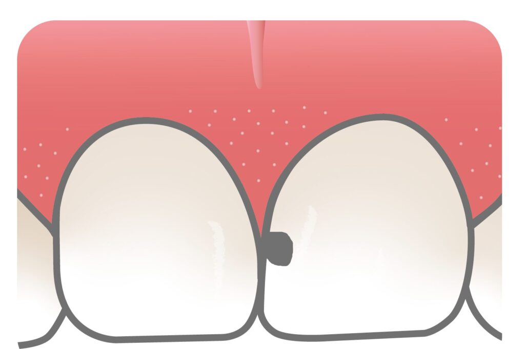 歯に真っ黒の穴が突然開きました