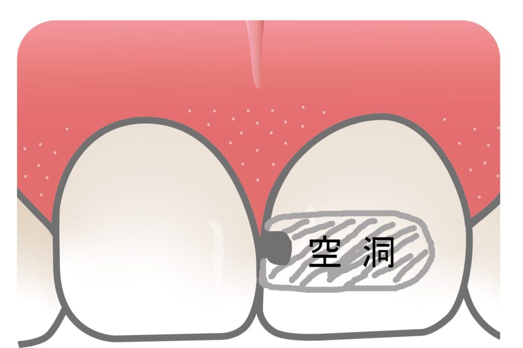 歯が折れてもおかしくないほど空洞があいていた